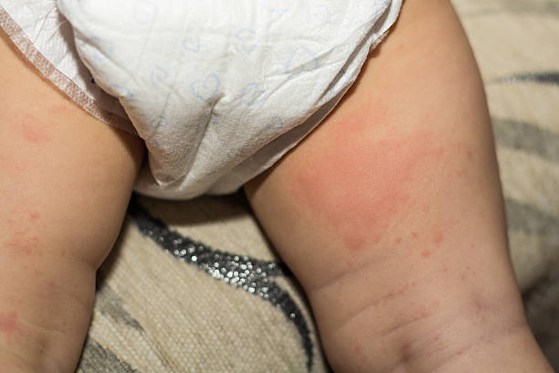 baby with diaper rash